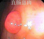 直腸息肉.jpg